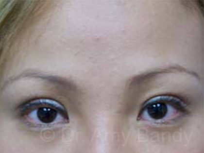 Asian Eye Surgery Before & After Patient #71