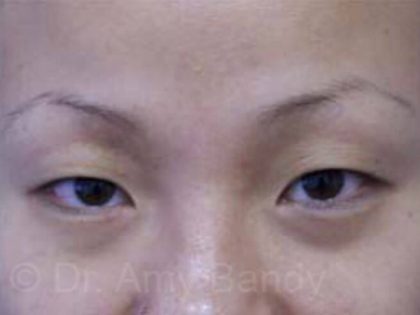 Asian Eye Surgery Before & After Patient #71