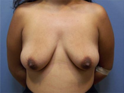 Breast Lift With Augmentation Before & After Patient #11704