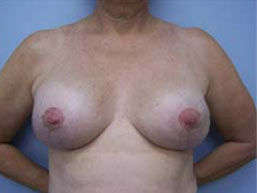 Breast Reduction Before & After Patient #6836