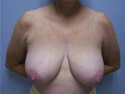 Breast Reduction Before & After Patient #6836