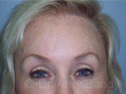 Brow Lift Before & After Patient #6839