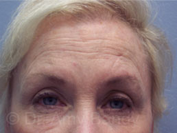 Brow Lift Before & After Patient #6839