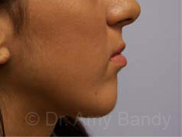 Chin Implant Before & After Patient #6842