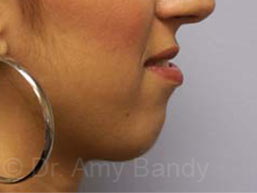 Chin Implant Before & After Patient #6842