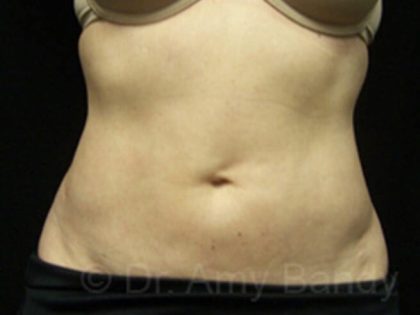 Coolsculpting Before & After Patient #6845