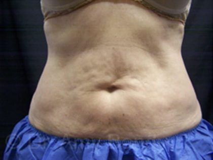 Coolsculpting Before & After Patient #6845