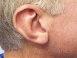 Earlobe Repair Face Before & After Patient #11762