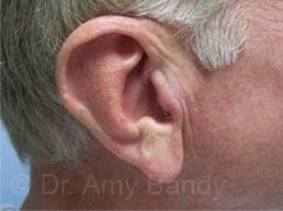 Earlobe Repair Face Before & After Patient #11762