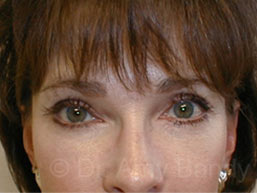 Eyelid Lift Before & After Patient #6876