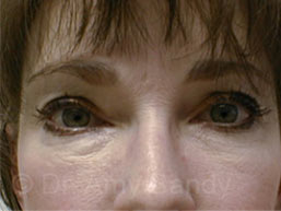 Eyelid Lift Before & After Patient #6876