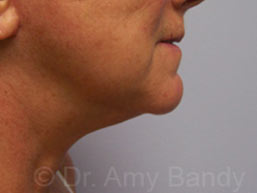 Face & Neck Lift Before & After Patient #7114