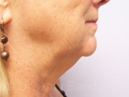 Face & Neck Lift Before & After Patient #7114