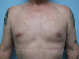 Gynecomastia Before & After Patient #7590