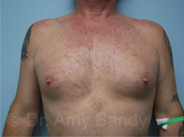 Gynecomastia Before & After Patient #7590