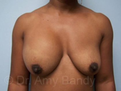 Large Breast Implants Before & After Patient #11814