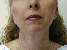 Neck Liposculpture Before & After Patient #9861