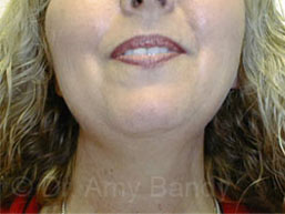 Neck Liposculpture Before & After Patient #9861