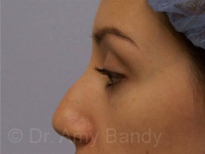 Rhinoplasty Before & After Patient #9915