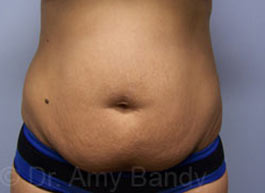 Tummy Tuck Before & After Patient #10151